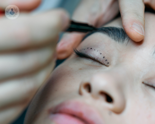 Young woman having dots placed on her eyelid for aesthetic eye surgery