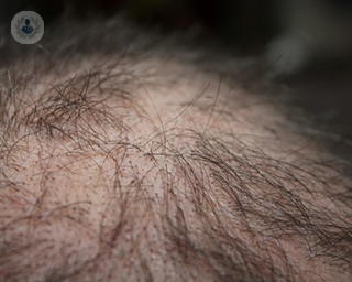 An image of a person balding