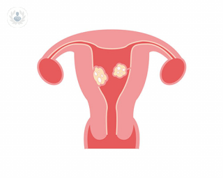 Uterus with fibroids.