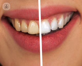 A picture comparing whitened teeth to not whitened teeth