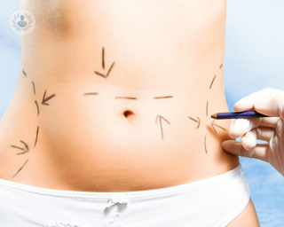Liposuction is a very popular treatment option for the removal of body fat