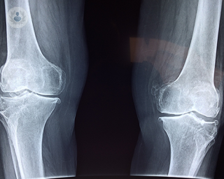 An x-ray scan of two knees