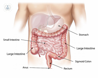 robotic colon surgery, colectomy, colon cancer, diverticulitis, proctocolectomy