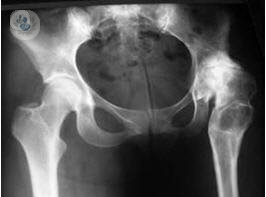An xray of a hip