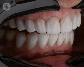 A dental examination of a person's teeth.