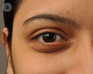 Eyelid malposition is an abnormal alignment of one or both eyelids and can lead to serious eye conditions if left untreated
