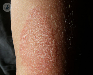 Does eczema persist into childhood?