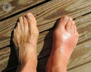 Bare feet on a boardwalk - the right one is swollen and red with arthritis