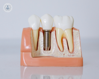 A 3D model showing dental implant placement.