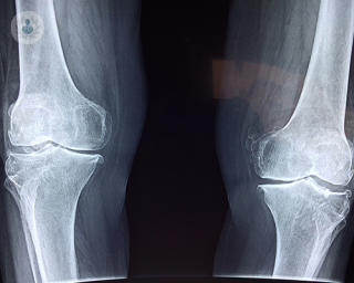 An x-ray of the knee.