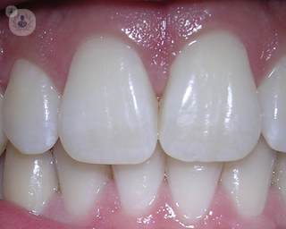 How are veneers placed on teeth?
