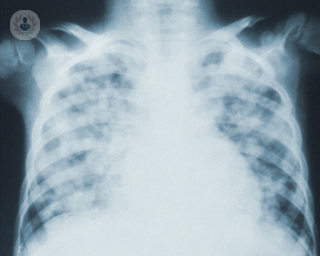 X-ray-shortness-of-breath