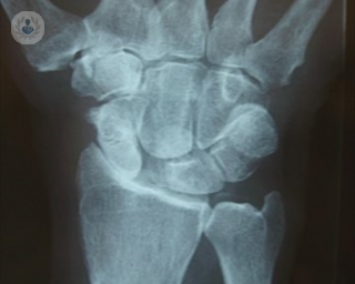 X-ray of a wrist with arthritis