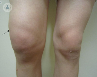A patient suffering from knee osteoarthritis.