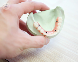 3D model of teeth showing signs of peri-implantitis