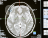 A brain CT scan