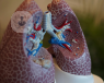 Lungs can be affected by bronchiectasis