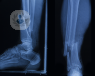 Two right leg x-rays side by side. The left scan of the leg shows side view of a broken bone, whereas the right shows the same break but from the front - the bone is a not stable and broken.