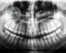 An X-ray scan of a mouth showing a human jaw and all teeth