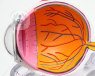refractive lens surgery treatment