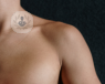 A close up of a body's upper chest, the area where the ICD is implanted