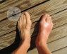 A person's two feet are standing on a wooden surface. The left foot is in regular condition whereas the right foot is painfully red and swollen due to gout.
