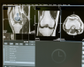 Computer screen showing results of a knee X-Ray