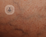 Close up of spider veins on someone's skin