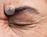 A person with cataracts. 