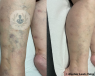 Before and after results of varicose veins treatment