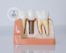 A dental implants model