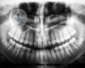 An X-ray showing partially erupted wisdom teeth