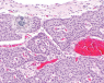 Pancreatic neuroendocrine tumours (NETs) cell slide