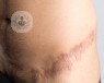 Scar from surgery on patient's hip