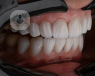 A dental examination of a person's teeth.