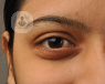 Eyelid malposition is an abnormal alignment of one or both eyelids and can lead to serious eye conditions if left untreated
