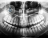 teeth-root-canal