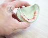 3D model of teeth showing signs of peri-implantitis