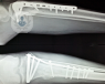 X-ray of internal fracture fixation