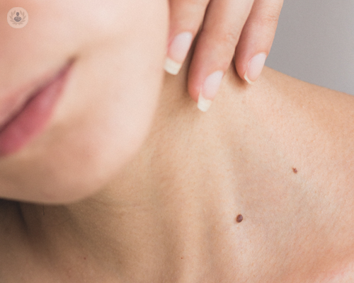 Young woman who requires skin tag removal