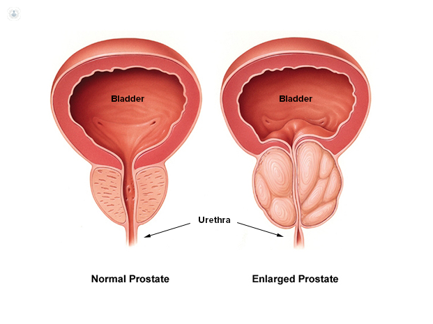 Rectal cancer with prostate invasion