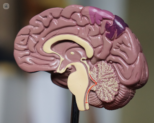 3D model of Alzheimer's brain