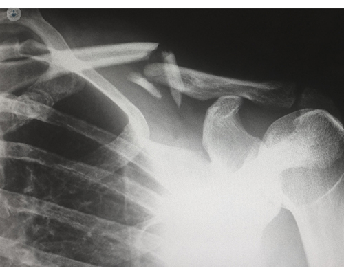 fracture clavicle