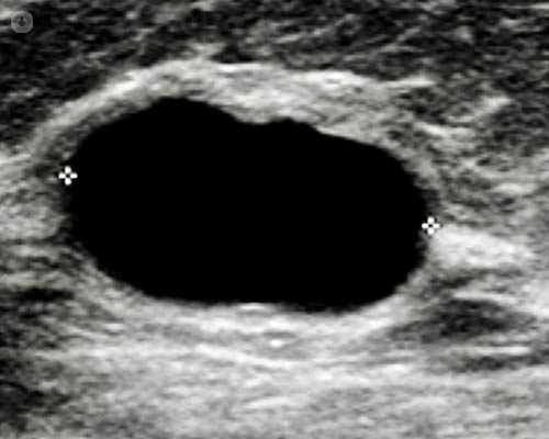 Breast cysts: should I be worried?