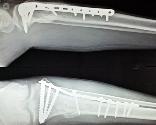 X-ray of fracture fixation