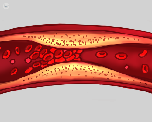Diagram of a blood clot from DVT