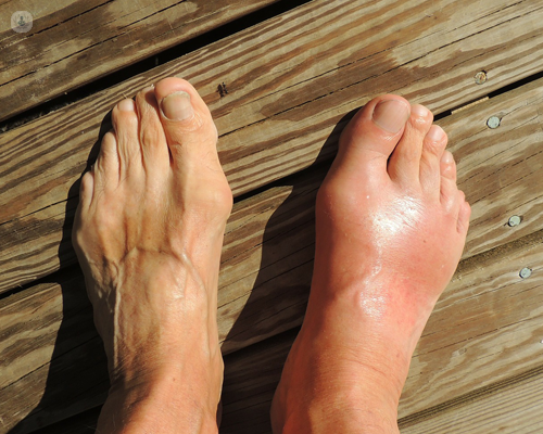 Bare feet on a boardwalk - the right one is swollen and red with arthritis