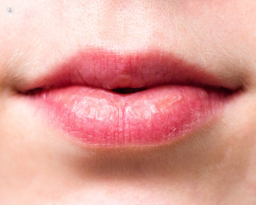 A close up of a woman's dry lips - a symptom of Sjogren's syndrome