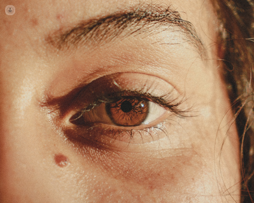 Girl with mole near eyelid