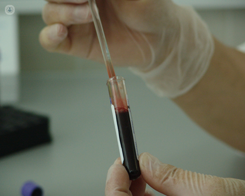 Analyst holding blood sample from a complete blood test for Sjogren's syndrome
